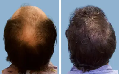 Before and After